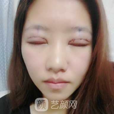 郑州周蔚做双眼皮怎么样?全新体验实例一览