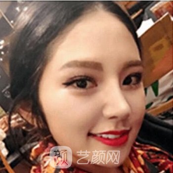 李湘原隆鼻实例，归功于医生不错的隆鼻技术，变美好多