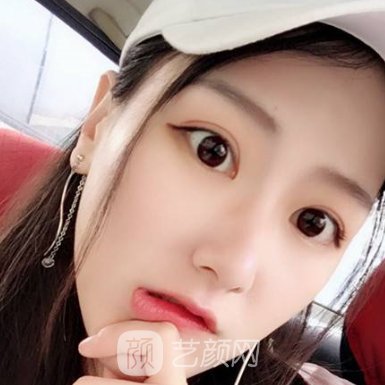 杭州维多利亚热玛吉除皱实例分享|附体验对比图