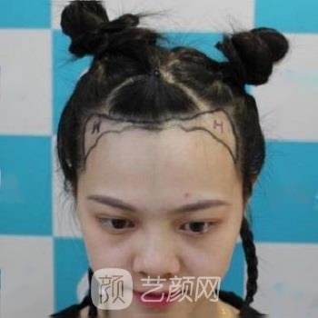 杭州大麦植发哪个医生好？医生简介+发际线种植实例分享