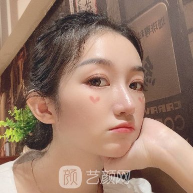武汉恩吉娜做玻尿酸面部填充技术好吗?亲测体验实例上线