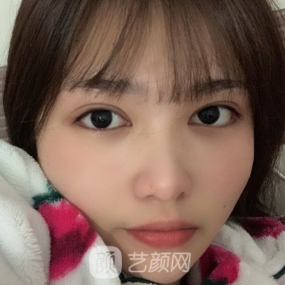 华美医院陈小剑双眼皮修复实例曝光|医生招牌实例展示
