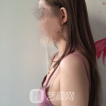 广州海峡医疗美容医院正规吗？多少钱？资质介绍+隆胸实例