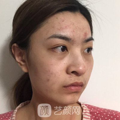 武汉亚韩整形医院注射除皱实例上线|成果自然无痕