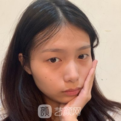 八大处李发成医生做面部脂肪填充怎么样？医生招牌实例出炉