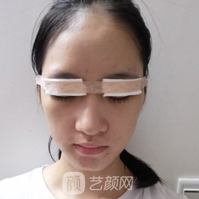 北京东方医院整形科吸脂实例公开|整个人变化了不少
