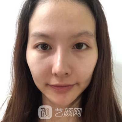 徐州华美整形价格表更新|内附全新面部脂肪填充实例