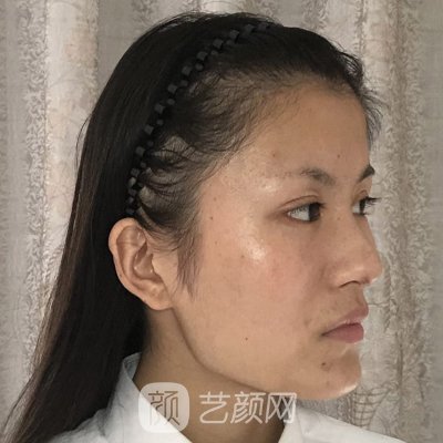 广州冯传波医生怎么样？全新面部脂肪填充实例上线