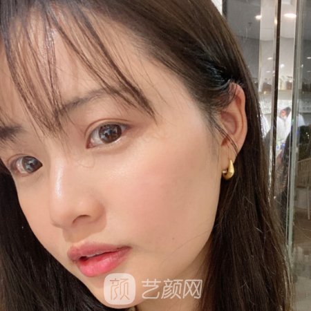 南京鼓楼医院整形科面部注射除皱实例展示]附体验对比图