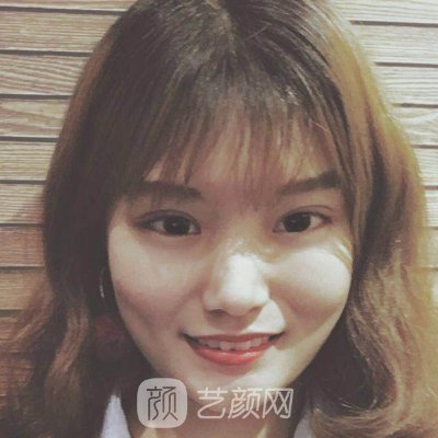 浙二医院美容整形科正规吗？全新双眼皮体验实例上线