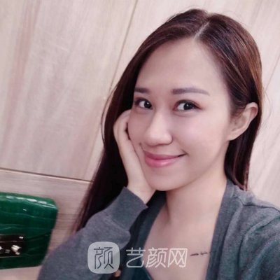 西安画美整形美容医院面部提升实例上线|亲测体验细节分享