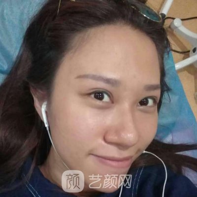 西安画美整形美容医院面部提升实例上线|亲测体验细节分享