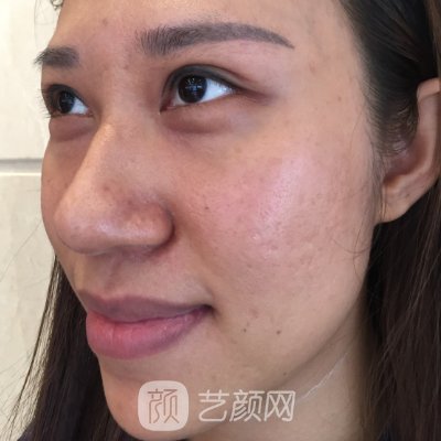 西安画美整形美容医院面部提升实例上线|亲测体验细节分享