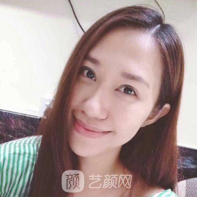 西安画美整形美容医院面部提升实例上线|亲测体验细节分享