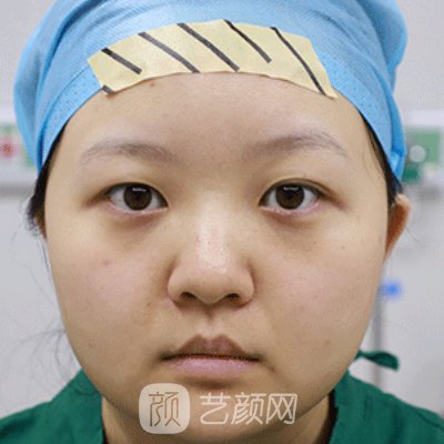 沈阳袁继龙医生做双眼皮好吗?医生实力及实例公开