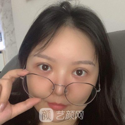 沈阳袁继龙医生做双眼皮好吗?医生实力及实例公开
