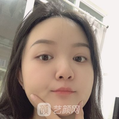 沈阳袁继龙医生做双眼皮好吗?医生实力及实例公开