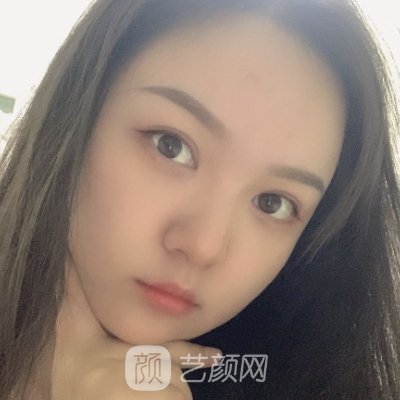 沈阳袁继龙医生做双眼皮好吗?医生实力及实例公开