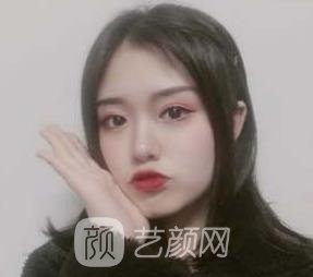 全切双眼皮7毫米修复图,术后稍微化个妆就漂亮的不得了