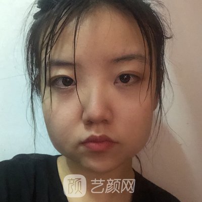 南京沈干医生下颌角整形实例曝光|90天修复细节一览