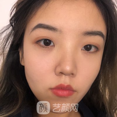 南京沈干医生下颌角整形实例曝光|90天修复细节一览