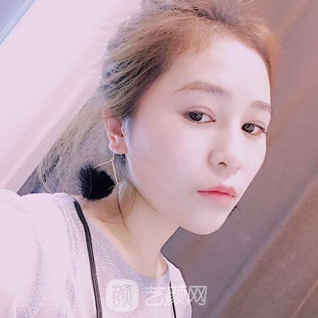 百嘉丽叶薇薇双眼皮修复怎么样?亲测修复实例展示