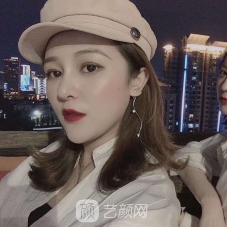 百嘉丽叶薇薇双眼皮修复怎么样?亲测修复实例展示