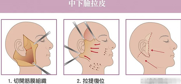 拉皮和线雕有什么区别