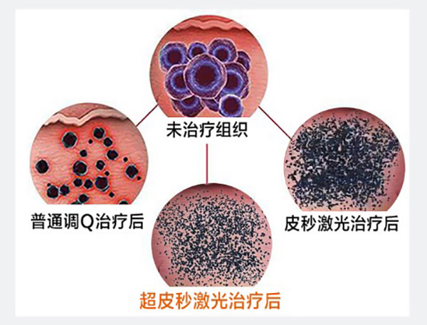 皮肤科在线医生免费咨询，超皮秒激光祛斑会反黑吗？