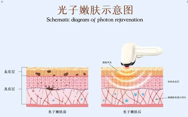 皮肤病免费问诊24小时在线回答，光子嫩肤能解决哪些面部问题