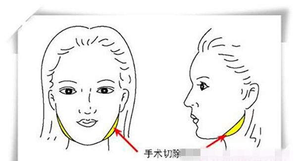 怎么削骨瘦脸