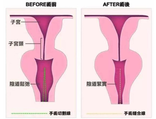 2023私密整形价格表大全，阴道紧缩/3D生物束带/菲蜜丽缩阴等收费