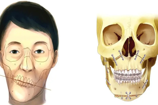 广大整形正颌手术