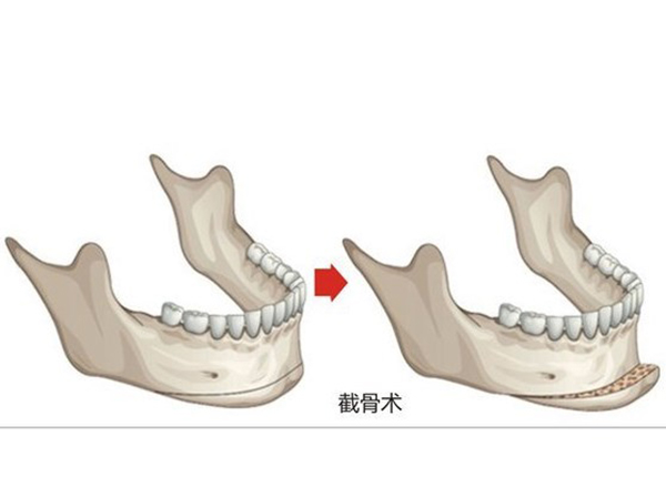 李志海磨骨手术好吗