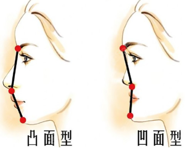 adm填充鼻基底的优点和缺点