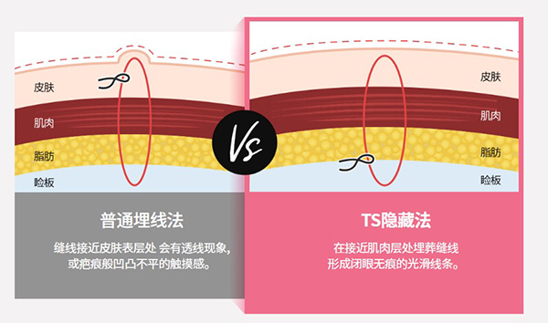 韩国ts整形双眼皮手术整形