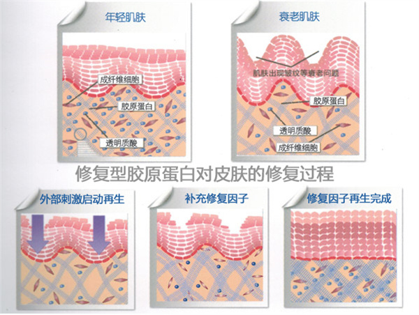 冰电波拉皮