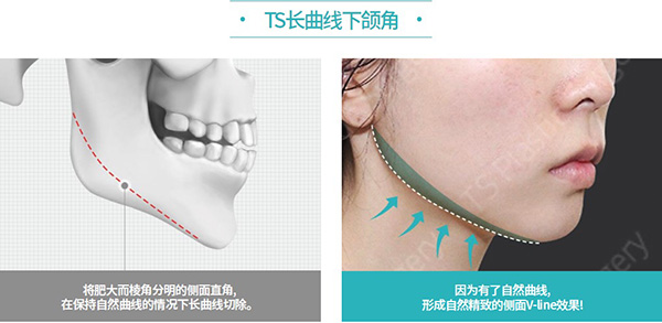韩国ts整形医院做轮廓怎么样