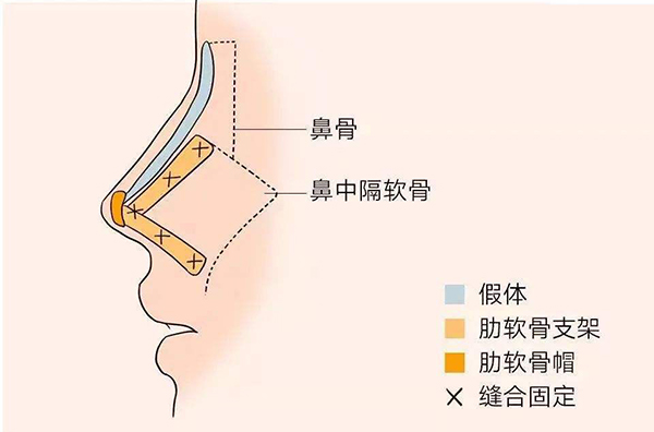 李劲良做鼻子口碑好吗