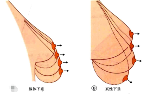 棒棒糖胸部提升原理