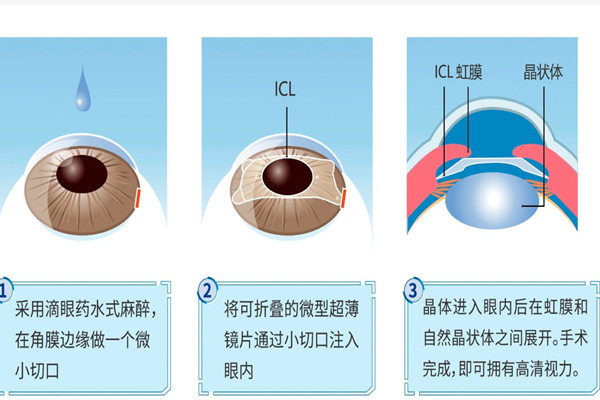 韩国近视手术价格表