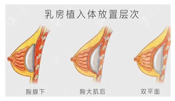 双平面隆胸一定要用内窥镜吗