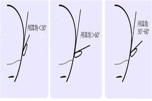 贴发耳的矫正角度