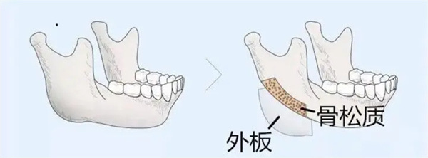 下颌角劈外板还会长出来吗