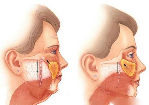筋膜悬吊面部提升术价格