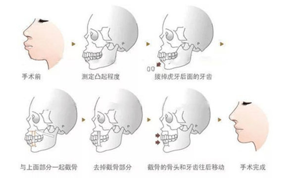 黄大勇做磨骨手术怎么样