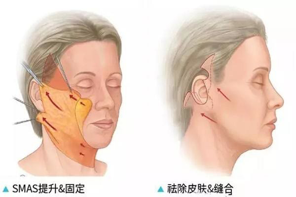 广州荔湾人民医院童颜SMAS小拉皮手术