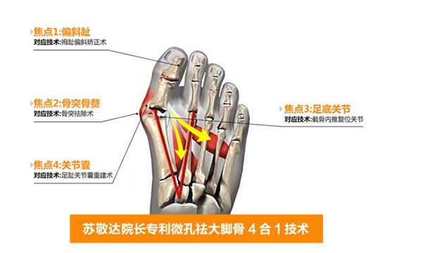 北京圣嘉新整形医院大脚骨怎么样啊