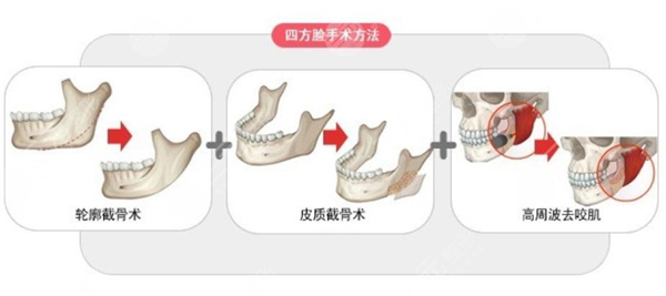 黄大勇下颌角怎么样？