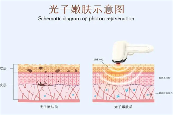 光子嫩肤祛痘